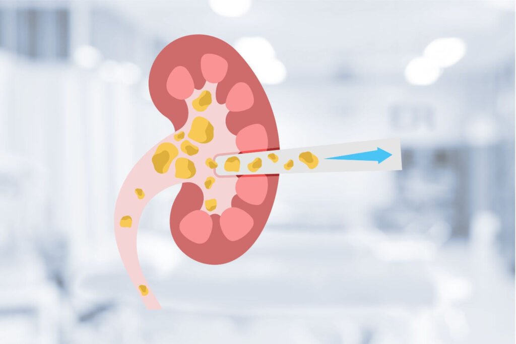 NEFROLITOTOMÍA PERCUTÁNEA