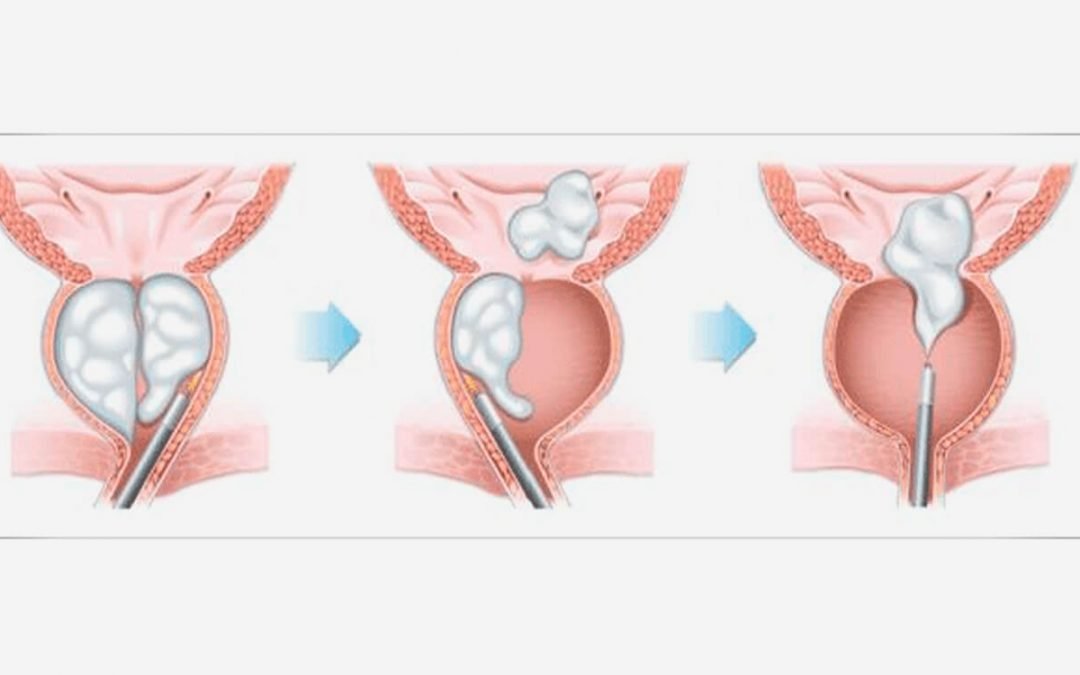 PROCEDIMIENTO DE HOLEP