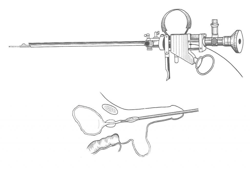 URETROTOMÍA ENDOSCÓPICA